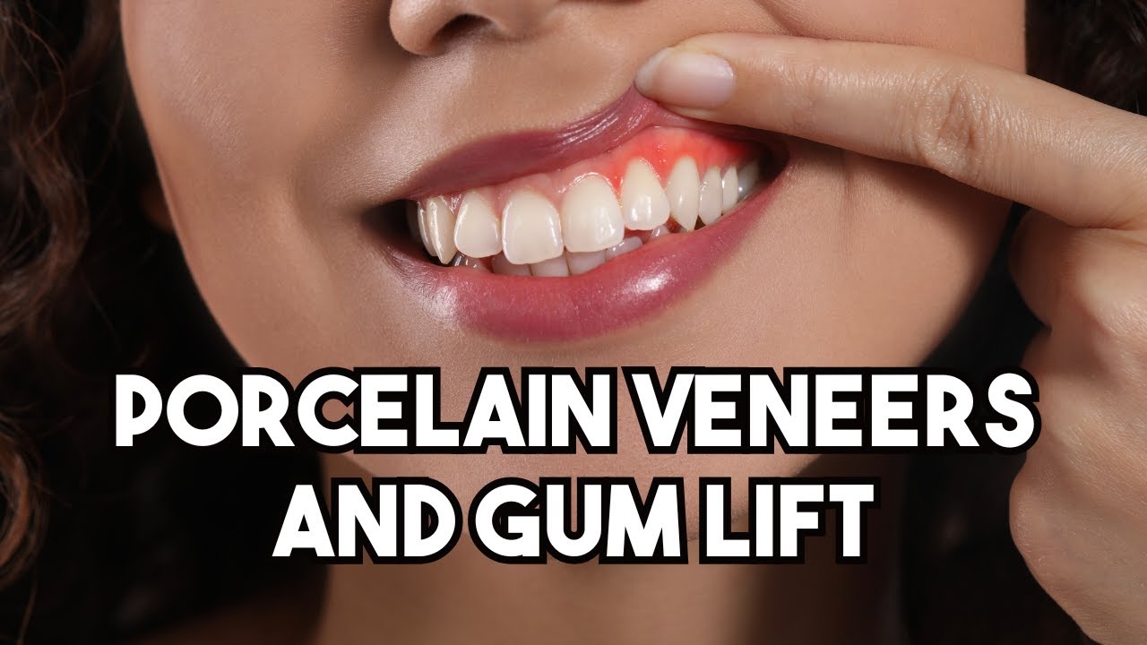 Case Study Porcelain Veneers and Gum lift