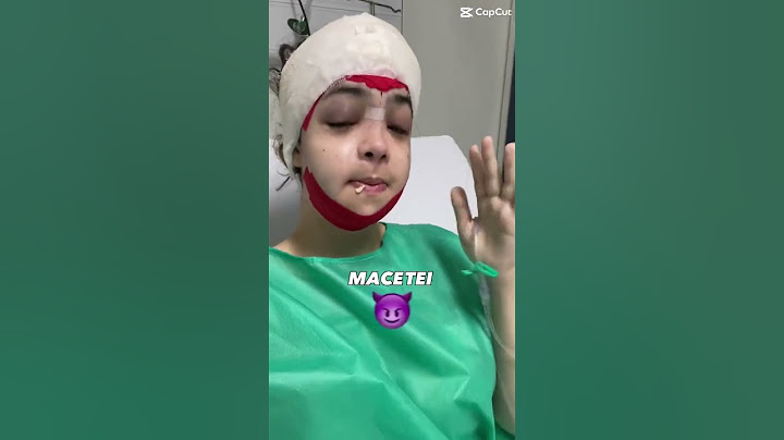 Minha CIRURGIA facial 💉
