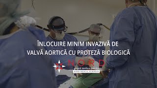 Înlocuire minim invazivă de valvă aortică cu proteză biologică - Prof. Dr. Lucian Dorobanțu