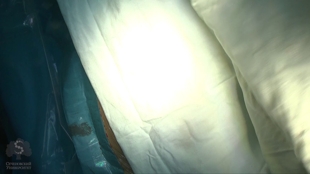 Правосторонняя гемиколэктомия с D3-лимфодиссекцией - YouTube