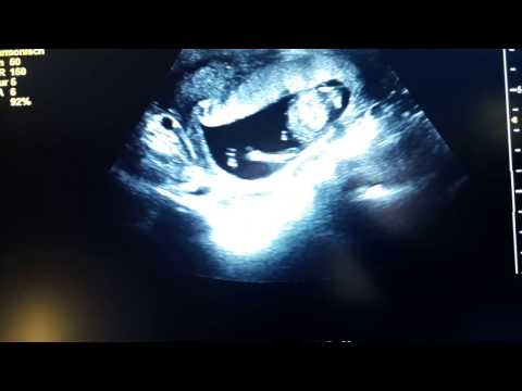 Video: Wer ist im Mutterleib aktiver Junge oder Mädchen?