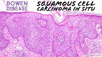 Squamous Cell Carcinoma In Situ (Bowen