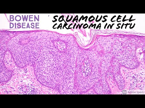Squamous Cell Carcinoma In Situ (Bowen&rsquo;s Disease) with Clear Cell Change: 5-Minute Pathology Pearls