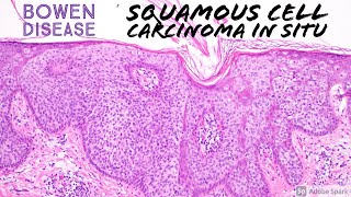 Squamous Cell Carcinoma In Situ (Bowen's Disease) with Clear Cell Change: 5-Minute Pathology Pearls