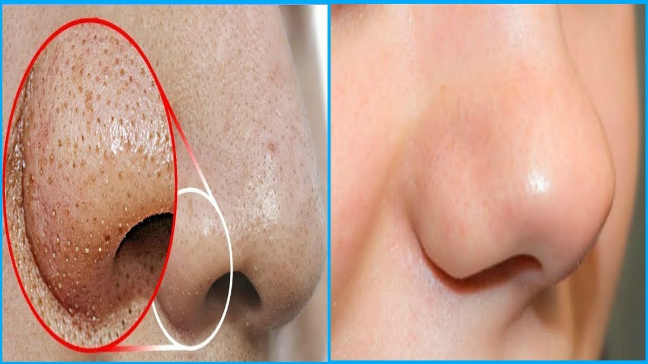 Only 2 Min. मे Blackheads हटाए-  HOW TO REMOVE BLACKHEADS PERMANENTLY - EASY AND PAINLESS METHOD - YouTube