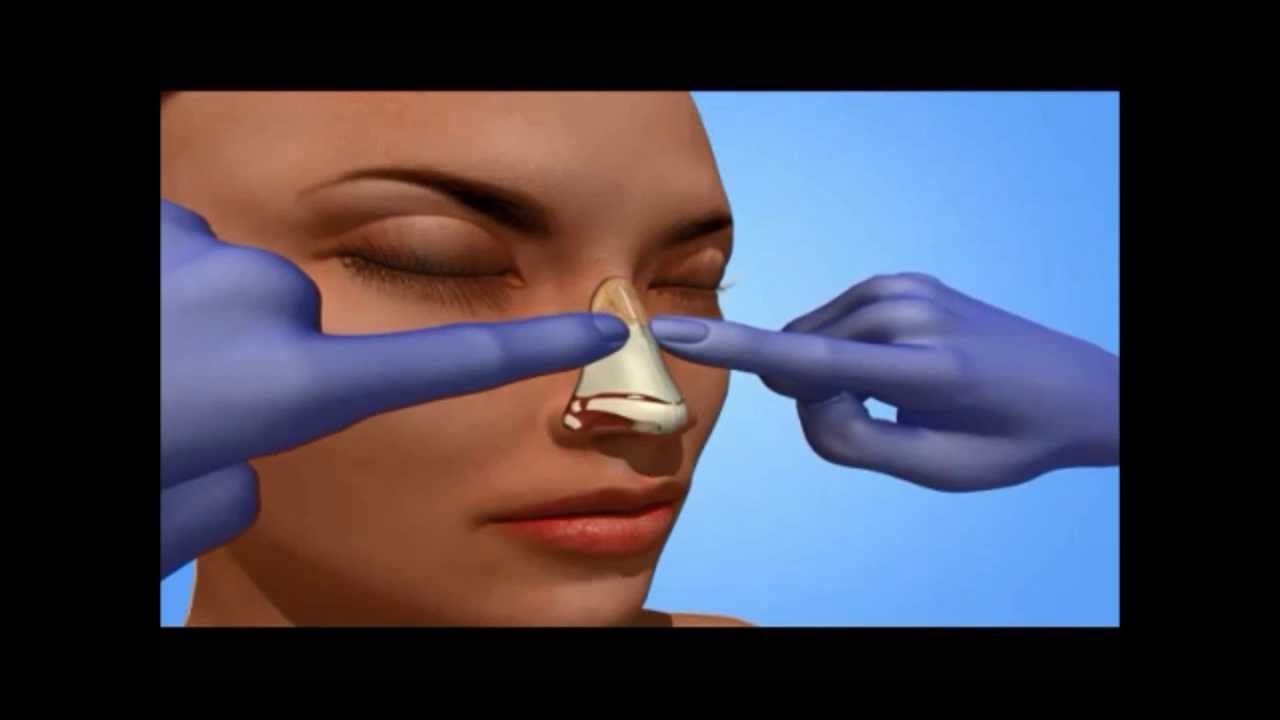 Rhinoplasty New York City Plastic Surgeon How the surgery is performed YouTube