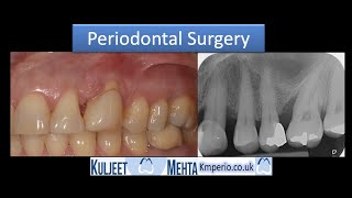 Periodontal Surgery with GTR-Before & After 7 years. by Dr Kuljeet Singh Mehta-Periodontist 2,106 views 1 year ago 4 minutes, 25 seconds