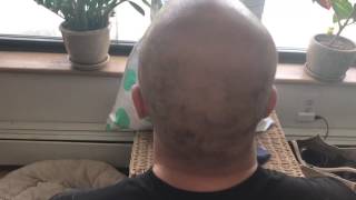 Laser Hair Removal On Scalp