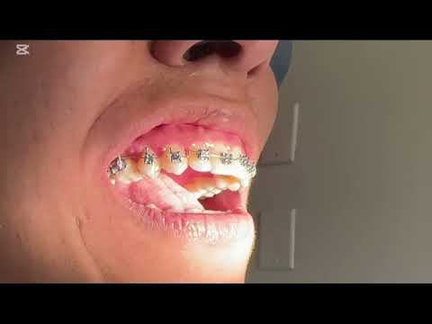 Brazo de palanca para enderezamiento molar