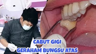 Tooth Extraction #5 : Pencabutan Gigi Geraham Bungsu Atas | Cabut Gigi