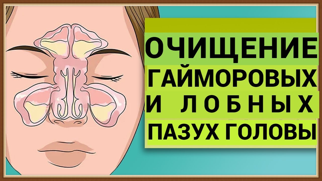 ЧИСТКА ГАЙМОРОВЫХ И ЛОБНЫХ ПАЗУХ ГОЛОВЫ - YouTube