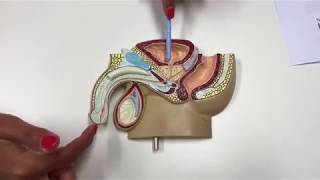 Rezum Procedure and SPC (catheter) screenshot 4