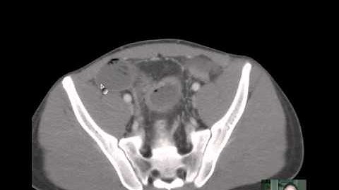 Crohn Dz w SBO CT.mp4