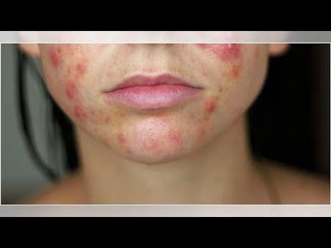 When Hidradenitis Suppurativa Affects the Face | Tita TV
