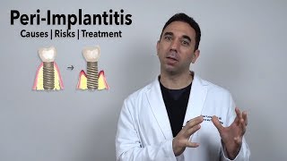 PeriImplantitis (Infected Dental Implant Treatment Options)