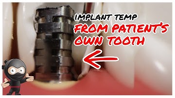 How to make an Immediate Load Temp