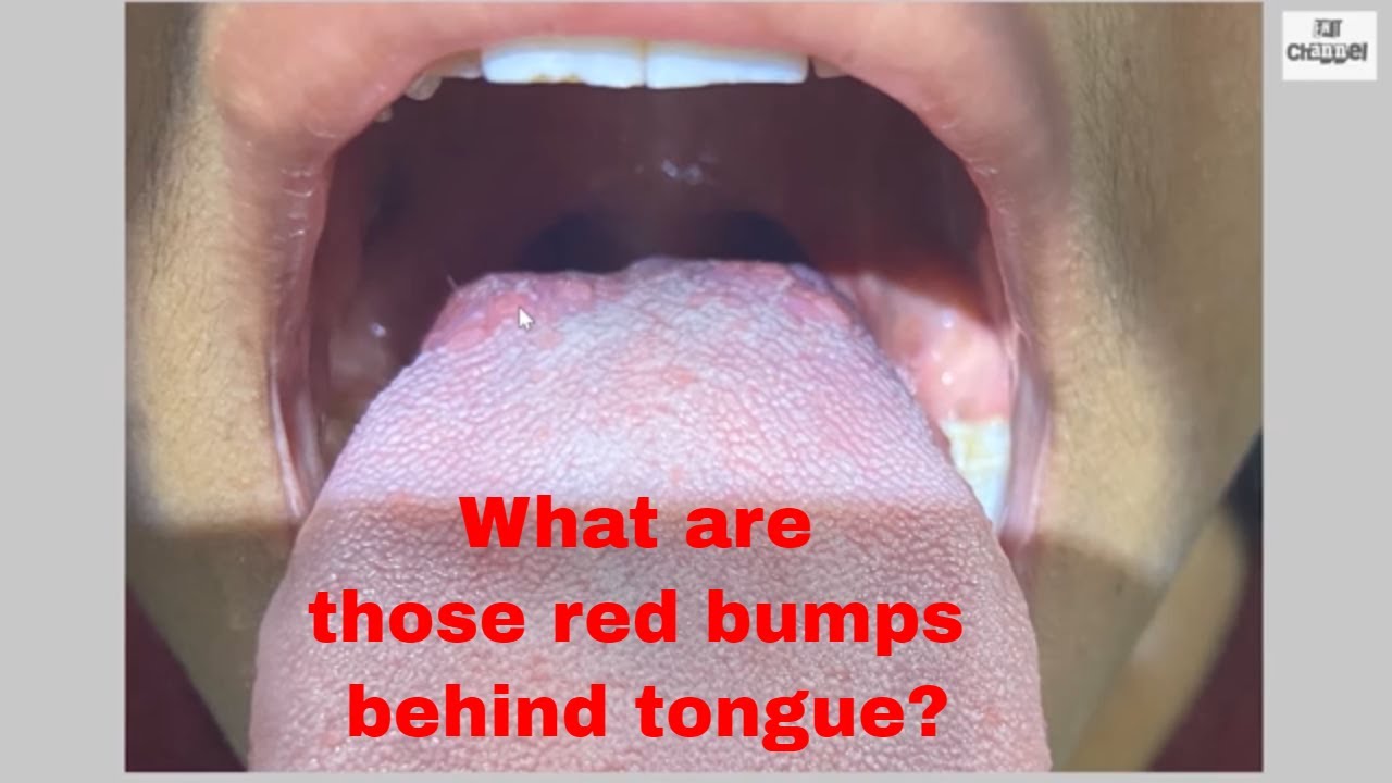 lommelygter Ringlet nuance What are Red bumps behind Tongue ? Taste Buds- How to keep them clean and  healthy? - YouTube