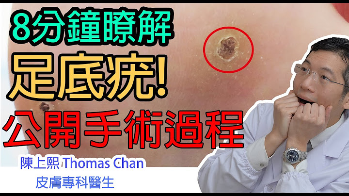 足底疣 | 皮膚專科醫生公開手術過程 | 什麼是足底疣？ | 預防的方法竟然是.... | 陳上熙醫生 - 天天要聞