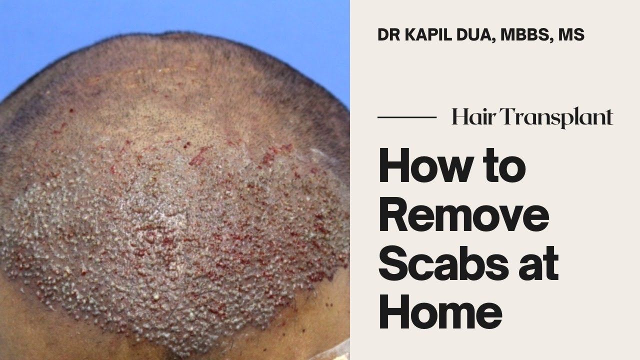 How to Remove Scabs after Hair Transplant at Home | Dr Kapil Dua - YouTube