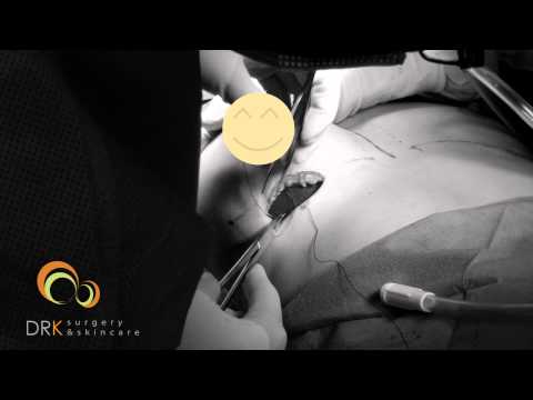 ตุ๊กตาเสริมหน้าอก mentor 350cc BLOODLESS Breast Augmentation @DRK