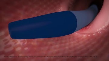 PICC Catheter Trimmed Tip vs Flex Video