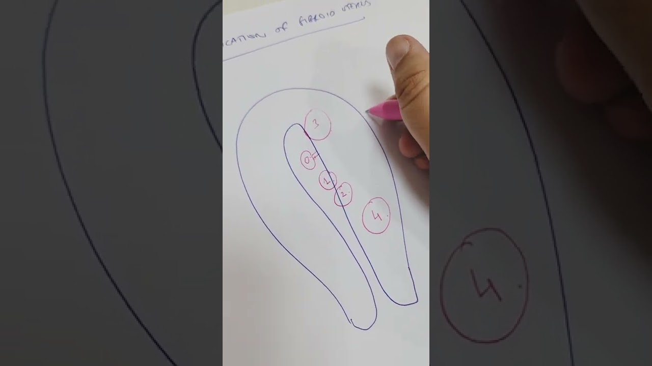 FIGO Classification of Fibroids