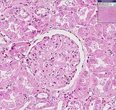 Discoid Lupus Erythematosus: Background, Etiology ...