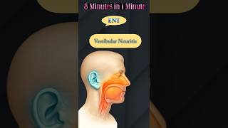 Vestibular Neuritis :: EyeENT :: PLAB 2 (UKMLA-CPSA) 8 min in 60 sec #plab2 #ukmla