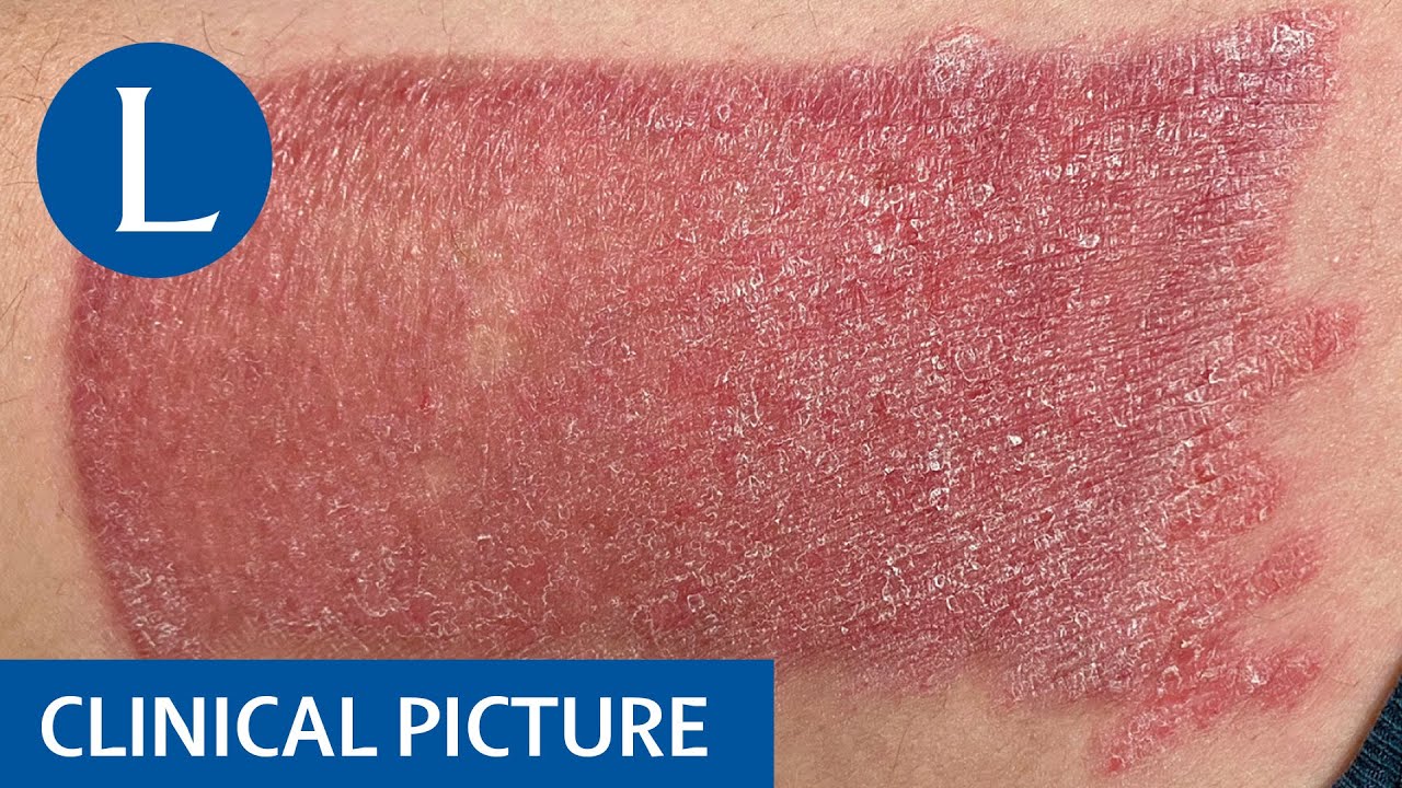 Psoriasis develops as an isomorphic response after skin graft - YouTube