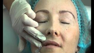 Контурная пластика Princess® Filler. Контурная пластика Princess® Filler.