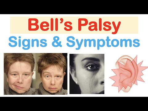 Bell’s Palsy (Facial Paralysis) Signs &amp; Symptoms (&amp; Why They Occur)