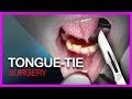 Tongue Tie  SURGERY