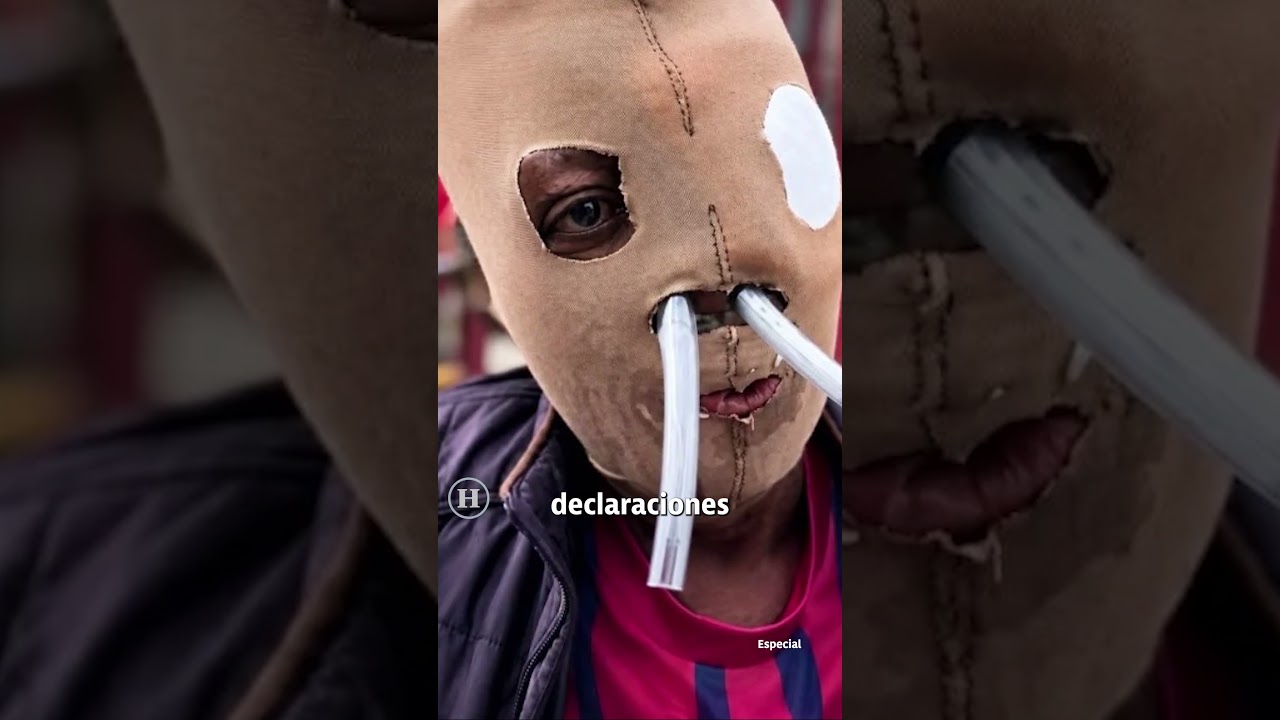Autorizan eutanasia a María Consuelo, mujer de 58 años víctima de un ataque con ácido