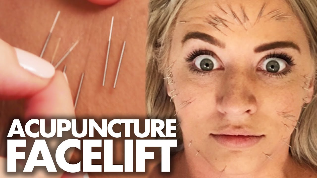 We Got 100 Acupuncture Needles In Our FACE!?! (Beauty Trippin) YouTube
