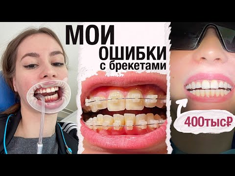 Мои Ошибки- Как потратить меньше ДЕНЕГ на Брекеты? Какие выбрать?