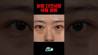 #눈밑 #다크서클 삭제 완료. #눈성형 #눈밑지방재배치 #비포애프터