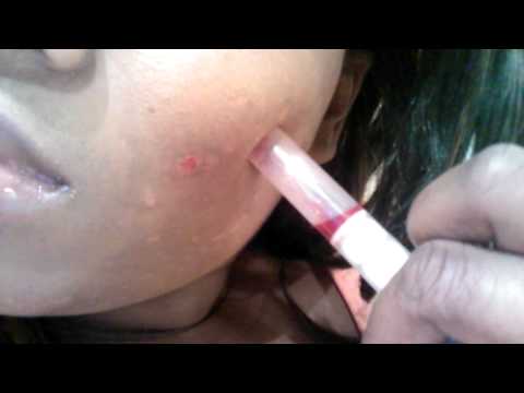 Cystic Acne Extraction