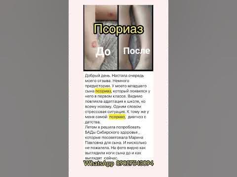 Псориаз. Средство от псориаза. - YouTube