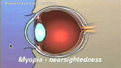 Myopia, Hyperopia, and Astigmatism