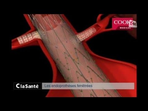 Vidéo: Anévrisme De L'aorte Abdominale - Symptômes Et Traitement