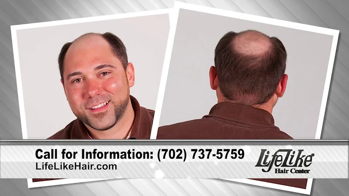 Hair Replacement Las Vegas Tony 15 LifeLike