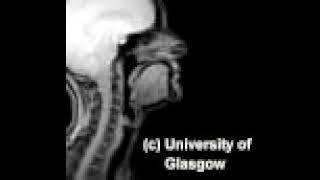 [VIDEO DELETED]  Voiceless alveolar click [kǃ]