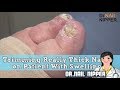 Revisted: Trimming Really Thick Nails on Patient With Swelling