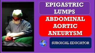 ABDOMINAL AORTIC ANEURYSM/  How to Diagnose & Treat/EPIGASTRIC LUMPS/ABDOMINAL LUMPS screenshot 2