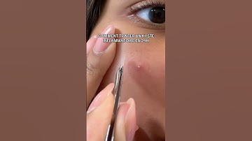 💡 Ne touchez pas le bouton si vous avez peur de le triturer, vous allez approfondir la tache #acne