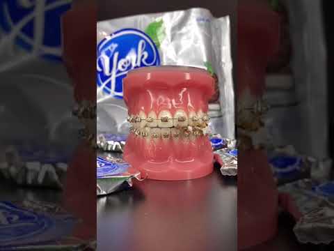 Video: Kan du äta twizzlers med tandställning?