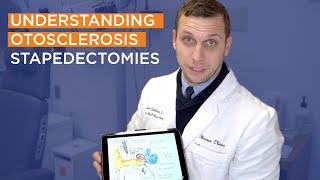 Understanding Otosclerosis Part 5 | What is a Stapedectomy? by House Institute 2,041 views 1 year ago 3 minutes, 29 seconds