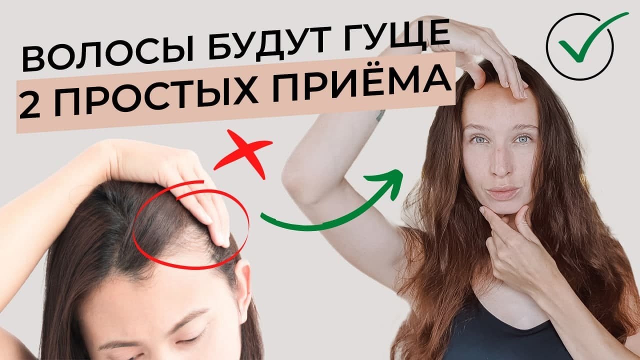 Выпадение волос | Как избавиться от залысин на лбу