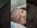 Cephalohematoma Explained: Blood Collection Under a Newborn’s Scalp 👶