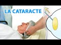 La cataracte explique par dr stopek